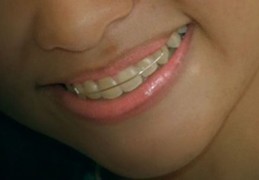 夢見牙套代表什麼？22個夢境解讀（梦见戴牙套，梦见摘牙套）