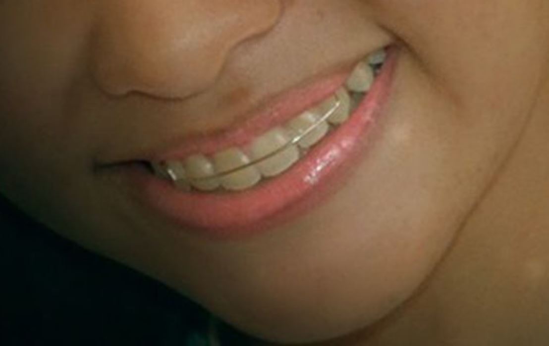 夢見牙套代表什麼?22個夢境解讀(梦见戴牙套,梦见摘牙套)-頭條解讀 夢見牙套代表什麼?22個夢境解讀(梦见戴牙套,梦见摘牙套)-頭條解讀